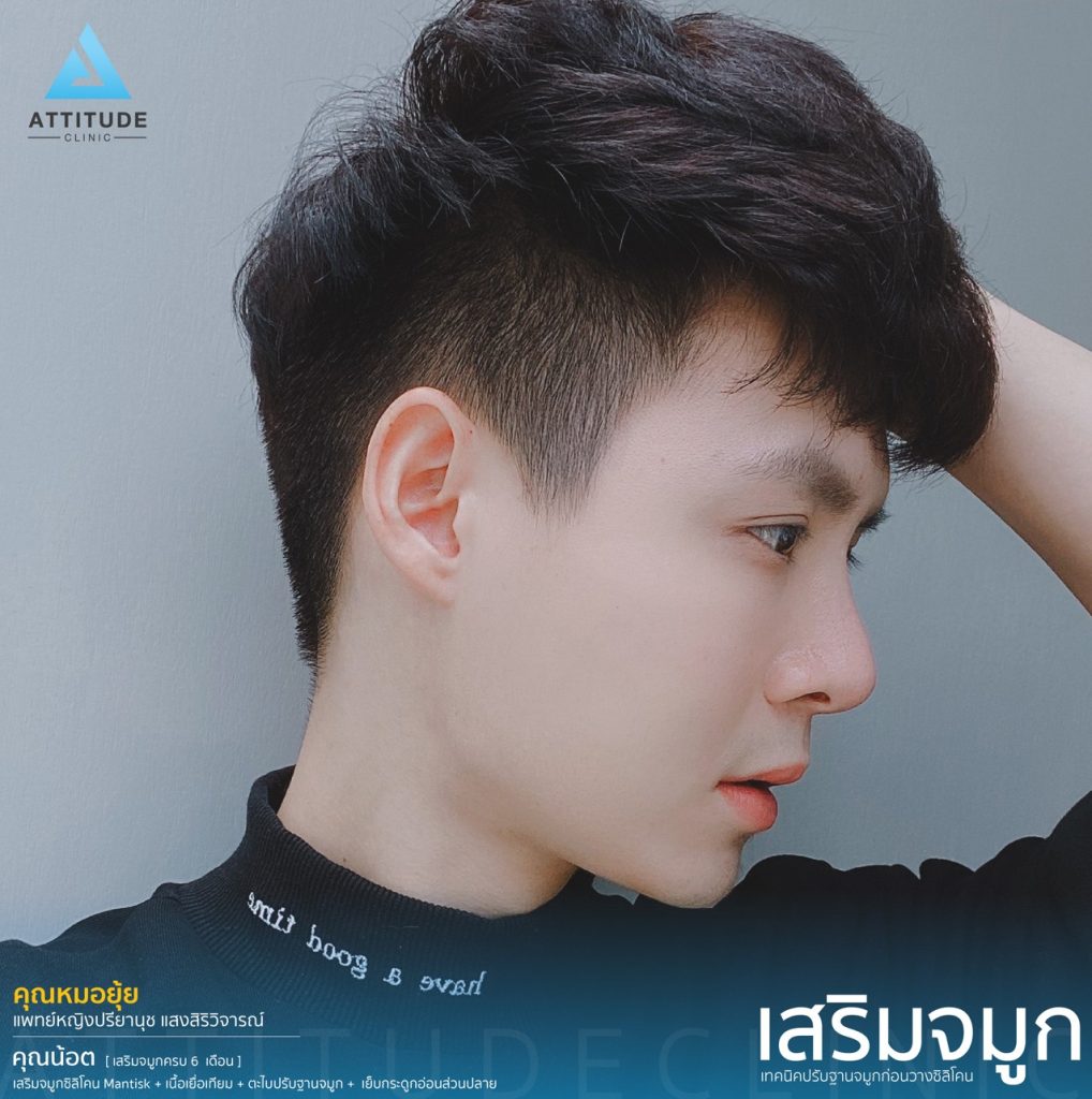 รีวิวเสริมจมูกผู้ชายเทคนิคใหม่  ปรับปลายจมูกให้เรียว สันจมูกชัด มิติชัด เน้นความธรรมชาติ และปลอดภัยในระยะยาว ที่ Attitude Clinic 