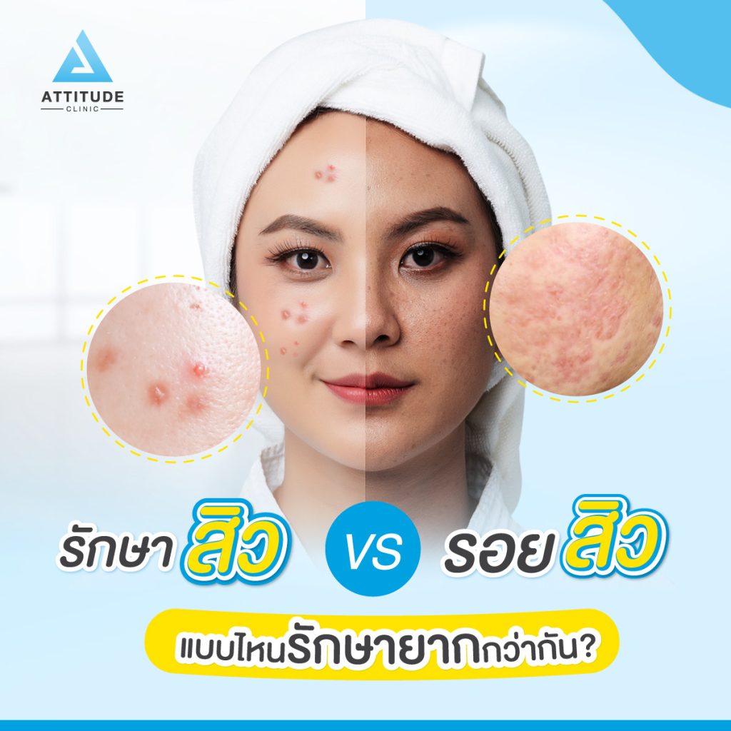 สุดยอดเลเซอร์ รักษารอยสิวเชียงใหม่ ที่ Attitude Clinic ด้วยเลเซอร์หน้าใส IPL ครอบคลุมทุกปัญหาผิว รอยแดง รอยดำจากสิวจางลง มั่นใจเกิน 100 หมออยู่ทุกวัน ดูแลเองทุกเคส รีวิวเพียบ