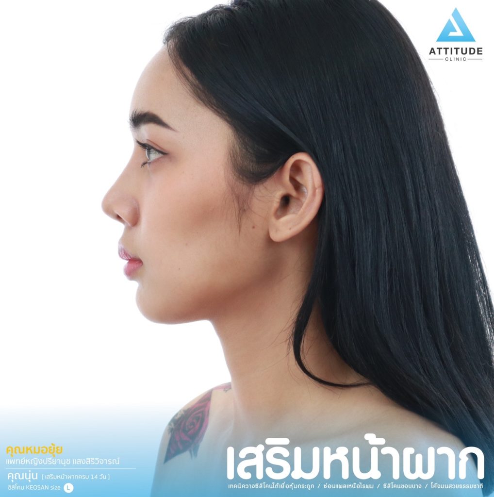 รีวิวเสริมหน้าผากด้วยซิลิโคน