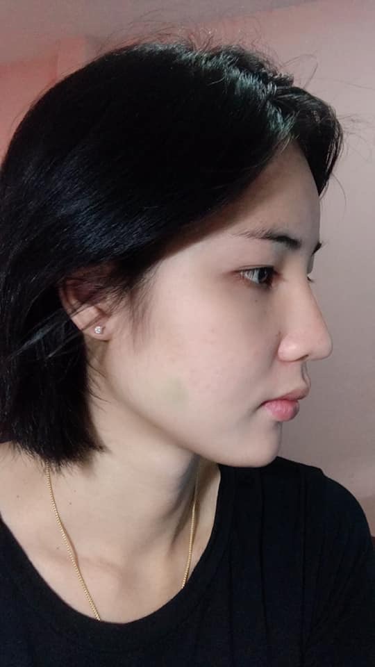 รีวิวเสริมหน้าผากด้วยซิลิโคน