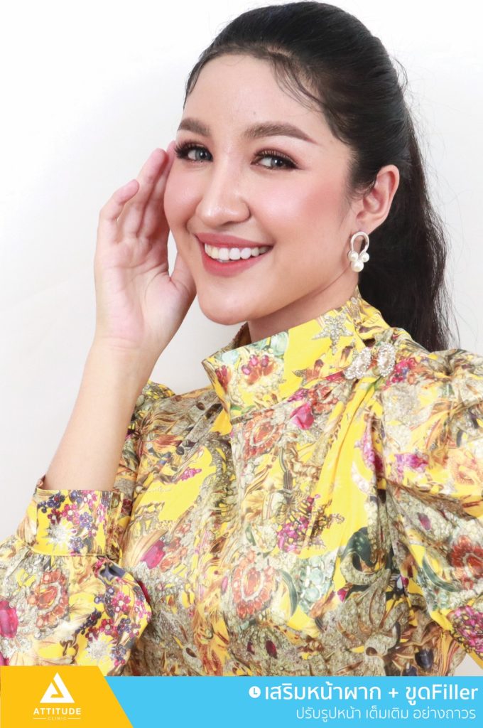 รีวิวเสริมหน้าผากด้วยซิลิโคน