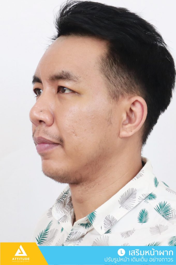 รีวิวเสริมหน้าผากด้วยซิลิโคน