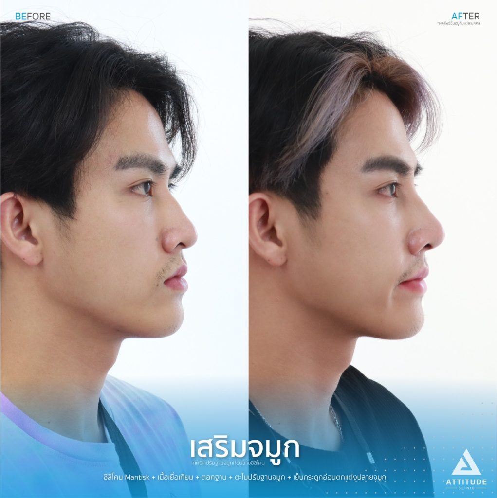 รีวิวเสริมจมูกผู้ชาย เทคนิคปรับฐานจมูกก่อนวางซิลิโคน ให้ทรงสวยเป็นธรรมชาติ แมนๆ ไม่โป๊ะ ที่ Attitue Clinic