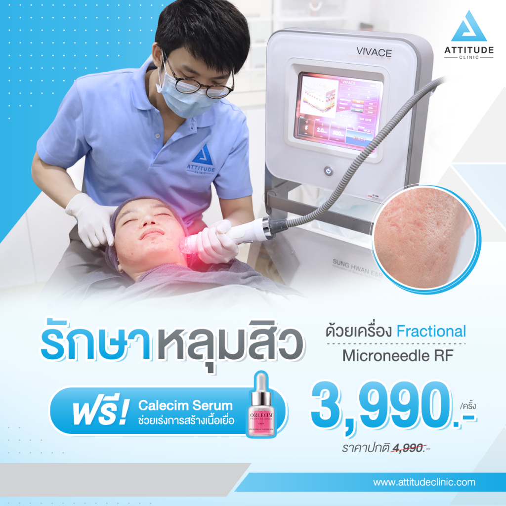 รักษาหลุมสิวลำปาง ที่ Attitude Clinic ด้วยเทคโนโลยี Fractional Micro Needle RF  เห็นผลตั้งแต่ครั้งแรก ไม่มีแผล ไม่ต้องพักฟื้น ฟื้นฟูผิวหน้าแบบ ? ?? ? ทำครั้งเดียว หลุมตื้นขึ้น รูขุมขนกระชับขึ้น ริ้วรอยลดลง 