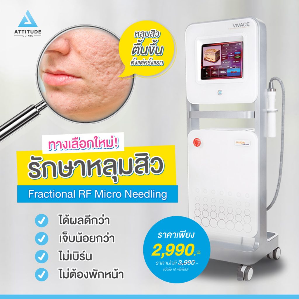 รักษาหลุมสิวเชียงใหม่ ที่ Attitude Clinic ด้วยเทคโนโลยี Fractional Micro Needle RF  เห็นผลตั้งแต่ครั้งแรก ไม่มีแผล ไม่ต้องพักฟื้น ฟื้นฟูผิวหน้าแบบ ? ?? ? ทำครั้งเดียว หลุมตื้นขึ้น รูขุมขนกระชับขึ้น ริ้วรอยลดลง 