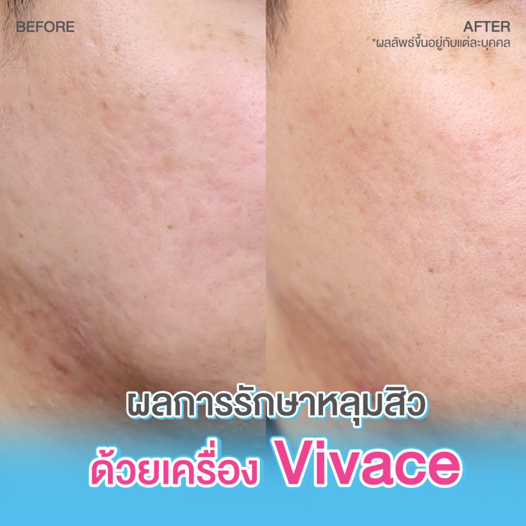 รีวิวรักษาหลุมสิว ด้วย Fractional Microneedle RF