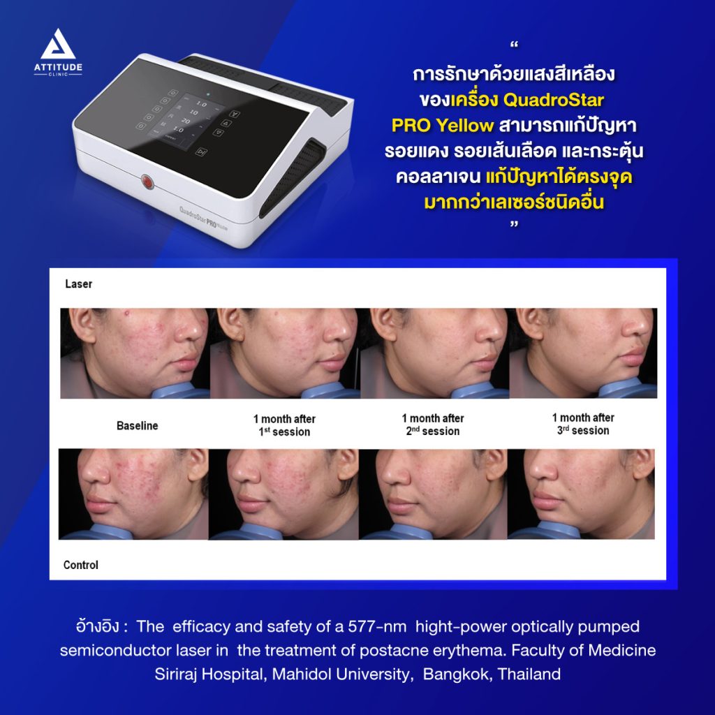 รีวิวผลการรักษาด้วย Quadrostar Pro Yellow laser