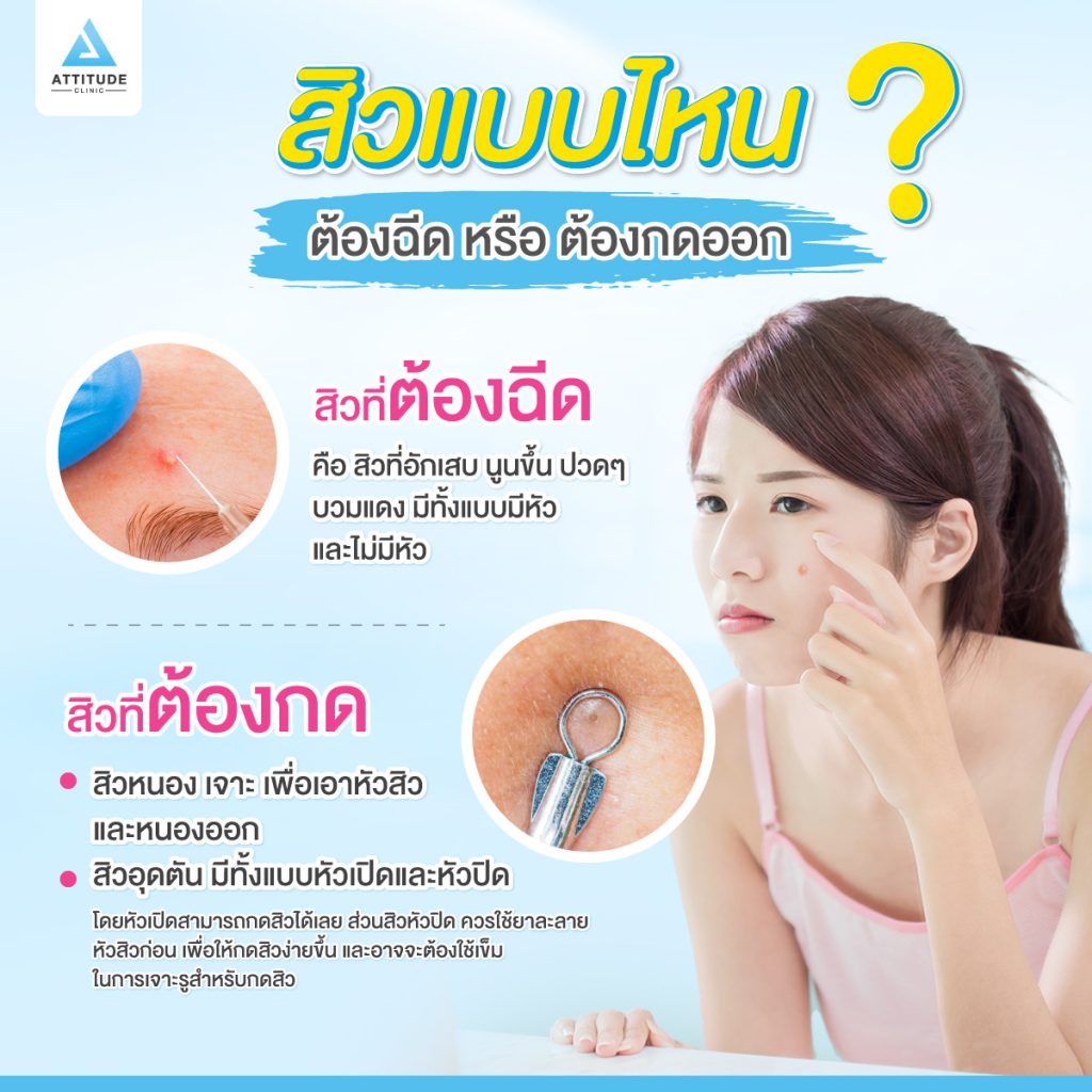 ไขข้อสงสัย สิวไหนควรกด สิวไหนควรฉีด ฟังทางนี้ Attitude Clinic มีคำตอบ หลักการรักษาสิวคือ การลดจำนวนการเกิดสิว และคุมเชื้อแบคทีเรียที่ก่อให้เกิดสิว (P.acne ) ปรับสมดุลให้ผิวเพื่อลดจำนวนสิวเกิดใหม่ 