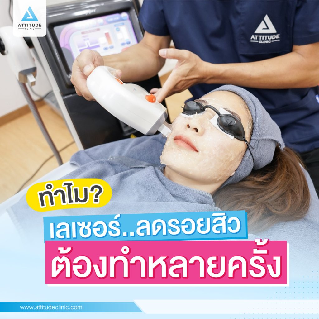 ไขข้อข้องใจ!! ทำไมทำเลเซอร์ลดรอยสิว "ต้องทำหลายครั้ง?" ทำครั้งเดียวหายเลยมั้ย?