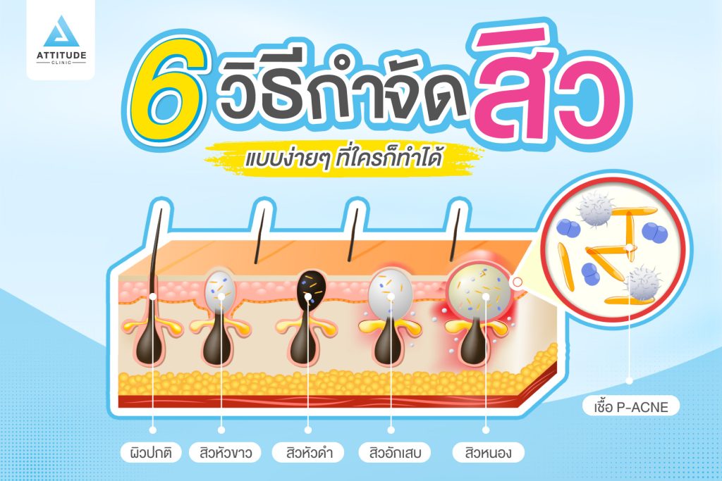 6 วิธีรักษาสิว แบบง่ายๆ ที่ใครก็ทำได้ สิวอักเสบ สิวอุดตัน หายเรียบ