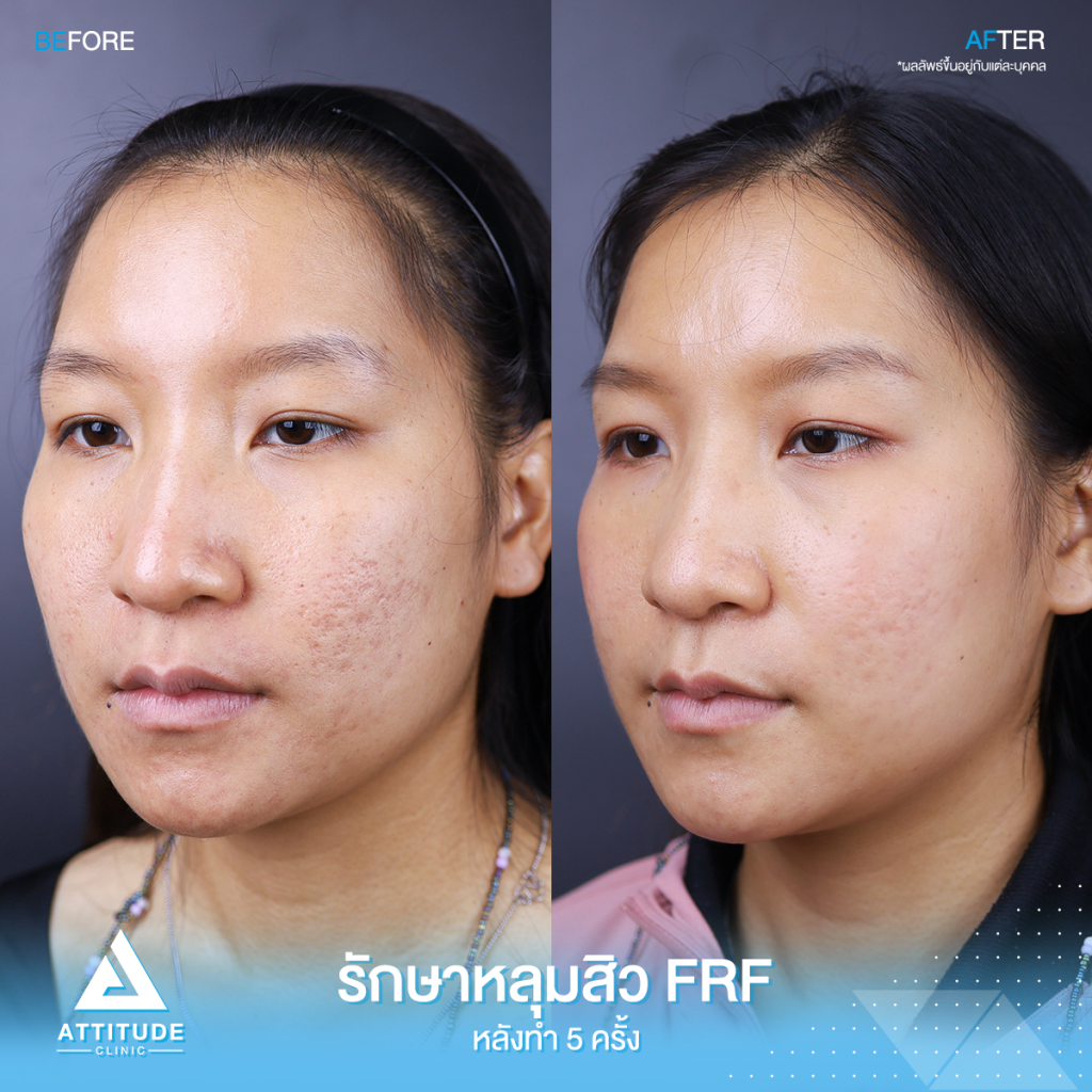 รีวิวรักษาหลุมสิวโปรแกรม FRF - Fractional Microneedle RF จำนวน ? ครั้ง รักษาแบบ ? ?? ? ทำครั้งเดียว ช่วยให้หลุมสิวตื้นขึ้น รูขุมขนกระชับขึ้น ริ้วรอยลดลง ที่ ​Attitude Clinic สาขาเชียงราย เชียงใหม่ ลำปาง