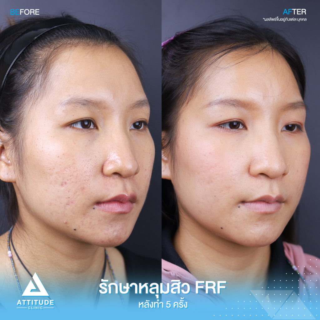 รีวิวรักษาหลุมสิวโปรแกรม FRF - Fractional Microneedle RF จำนวน ? ครั้ง รักษาแบบ ? ?? ? ทำครั้งเดียว ช่วยให้หลุมสิวตื้นขึ้น รูขุมขนกระชับขึ้น ริ้วรอยลดลง ที่ ​Attitude Clinic สาขาเชียงราย เชียงใหม่ ลำปาง 