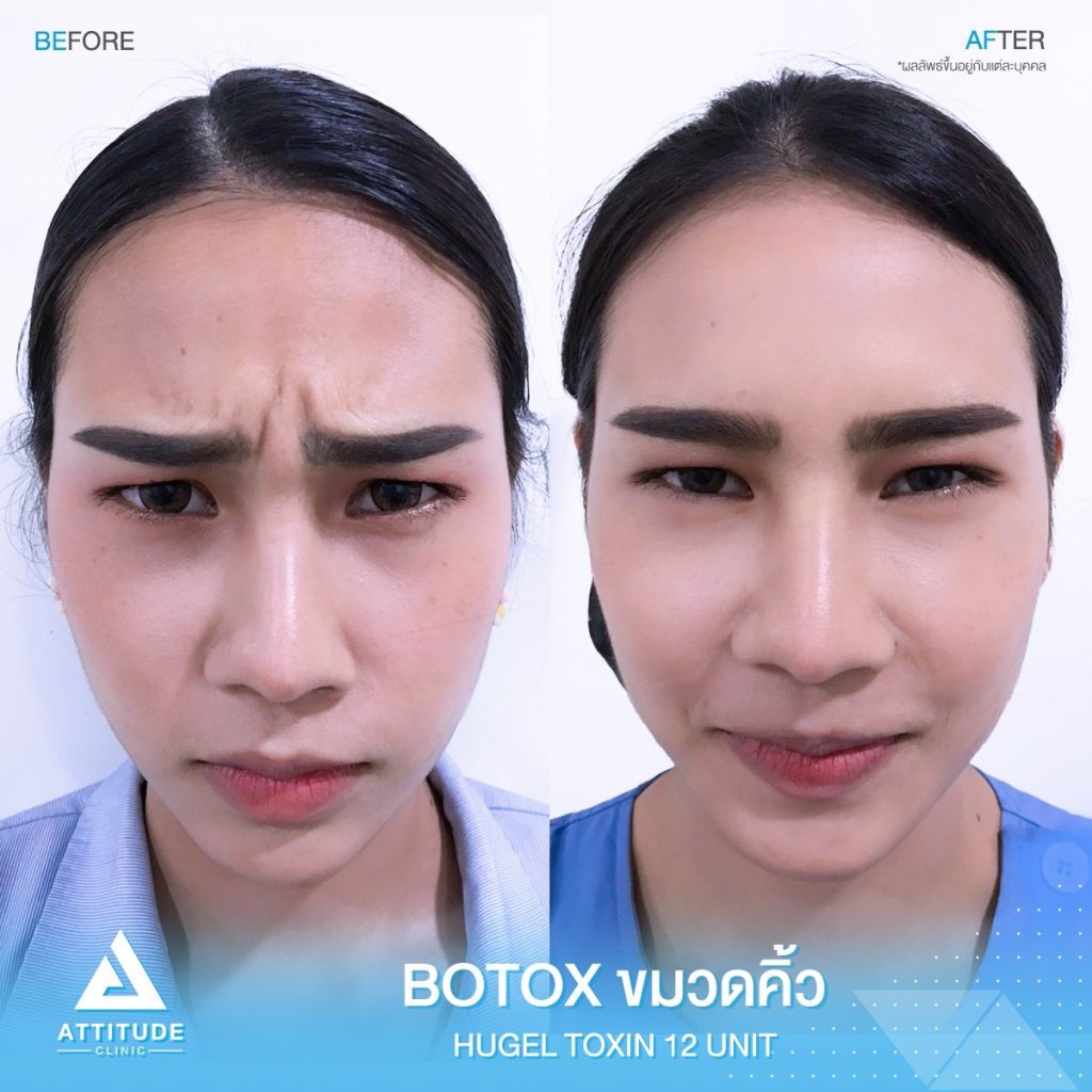 รีวิวฉีด Botox Hugel ลดริ้วรอยขมวดคิ้ว