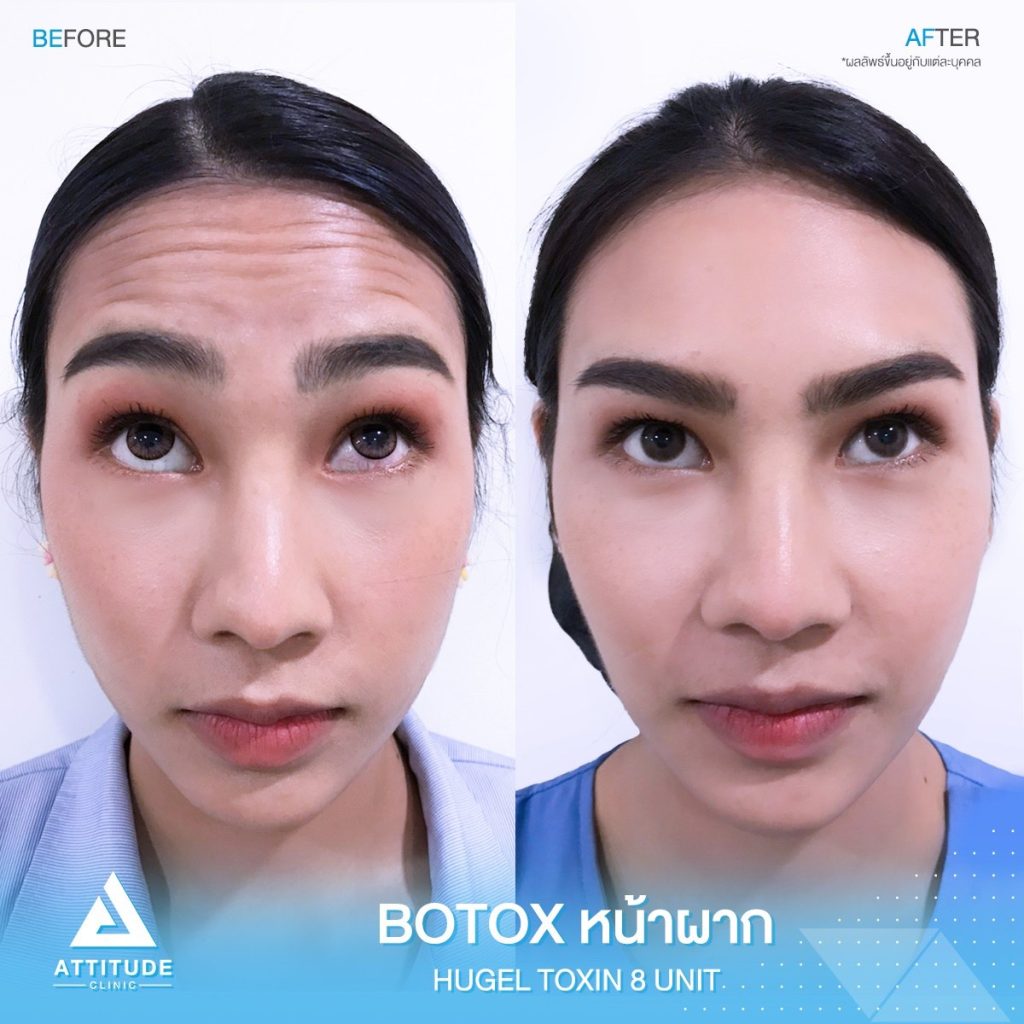 รีวิวฉีด Botox Hugel ลดริ้วรอยหน้าผาก