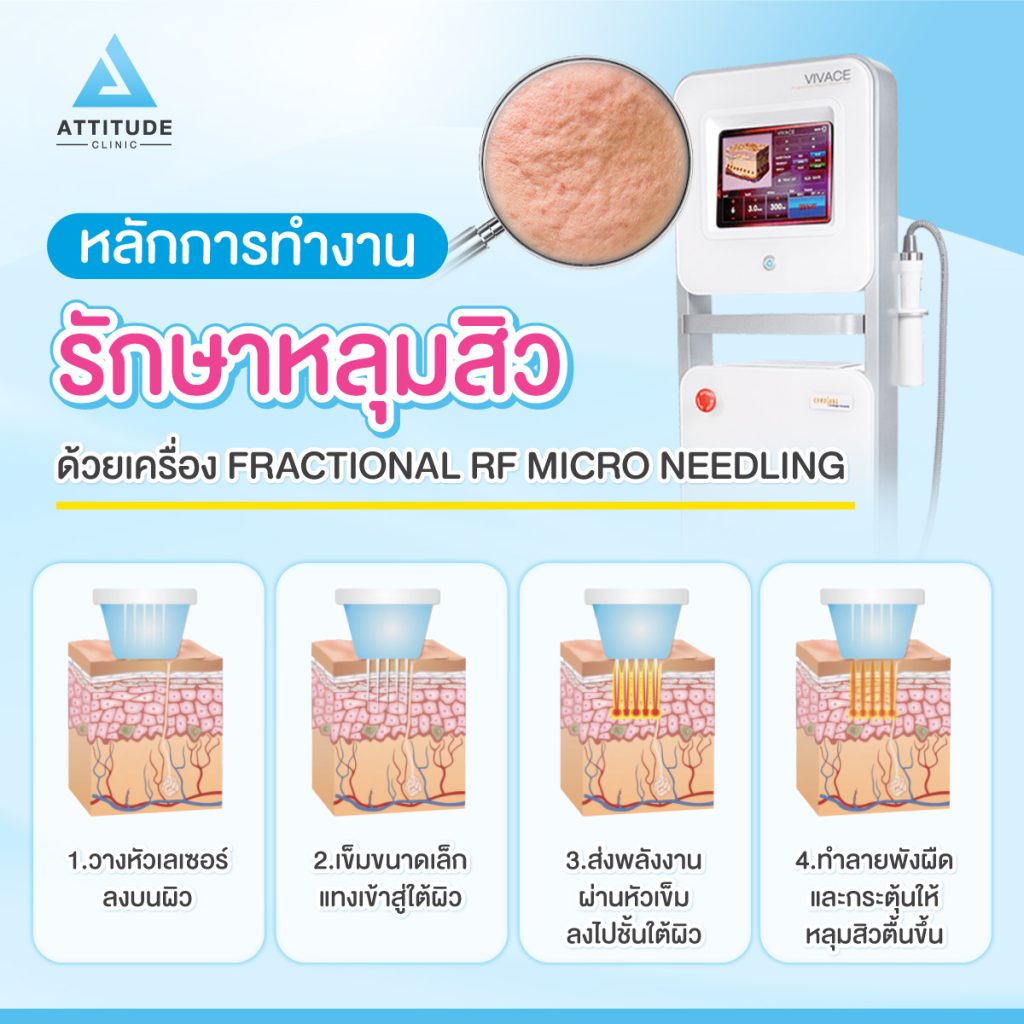 รักษาหลุมสิวลำปาง ที่ Attitude Clinic ด้วยเทคโนโลยี Fractional Micro Needle RF  เห็นผลตั้งแต่ครั้งแรก ไม่มีแผล ไม่ต้องพักฟื้น ฟื้นฟูผิวหน้าแบบ ? ?? ? ทำครั้งเดียว หลุมตื้นขึ้น รูขุมขนกระชับขึ้น ริ้วรอยลดลง 