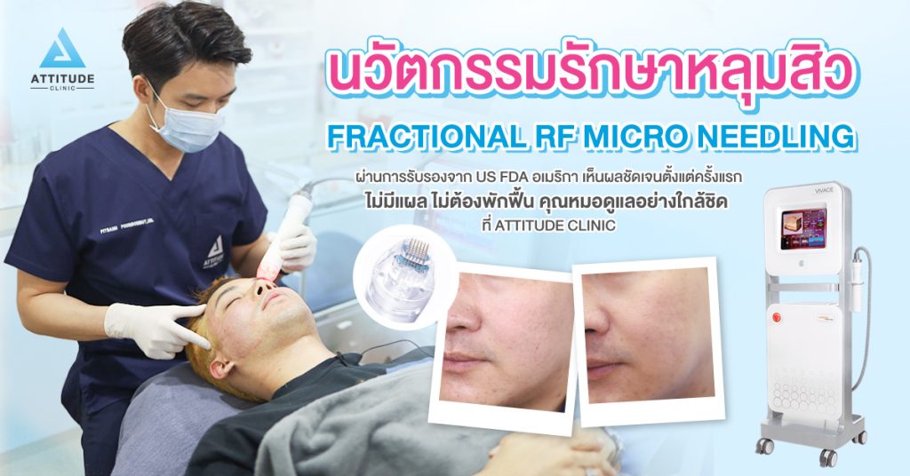 รักษาหลุมสิวลำปาง ที่ Attitude Clinic ด้วยเทคโนโลยี Fractional Micro Needle RF เห็นผลตั้งแต่ครั้งแรก ไม่มีแผล ไม่ต้องพักฟื้น ฟื้นฟูผิวหน้าแบบ ? ?? ? ทำครั้งเดียว หลุมตื้นขึ้น รูขุมขนกระชับขึ้น ริ้วรอยลดลง