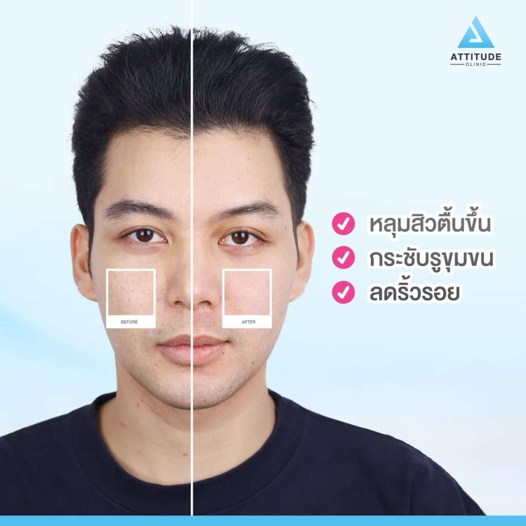 รักษาหลุมสิวลำปาง ที่ Attitude Clinic ด้วยเทคโนโลยี Fractional Micro Needle RF  เห็นผลตั้งแต่ครั้งแรก ไม่มีแผล ไม่ต้องพักฟื้น ฟื้นฟูผิวหน้าแบบ ? ?? ? ทำครั้งเดียว หลุมตื้นขึ้น รูขุมขนกระชับขึ้น ริ้วรอยลดลง 