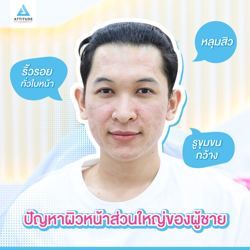 รักษาหลุมสิว ด้วยเครื่อง Fractional Micro Needling RF 