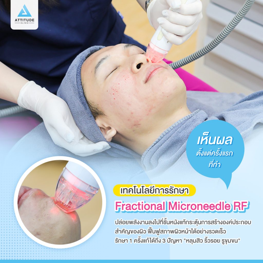 รักษาหลุมสิว ด้วยเครื่อง Fractional Micro Needling RF