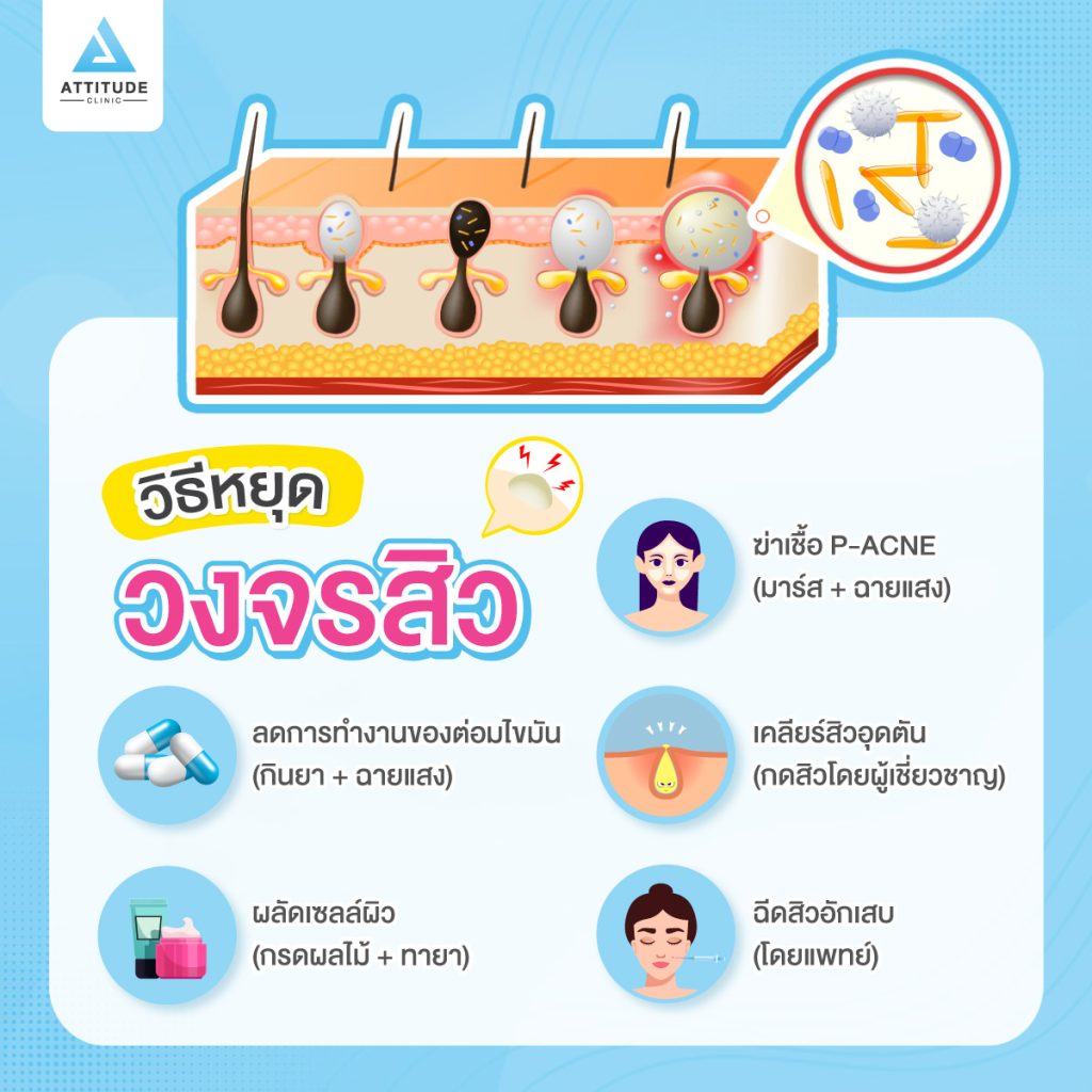 รักษาสิวที่ต้นเหตุ รักษาสิวแบบตรงจุด สิวอักเสบ สิวอุดตัน สิวไม่มีหัว ไม่ว่าจะสิวอะไรก็รักษาให้หายได้