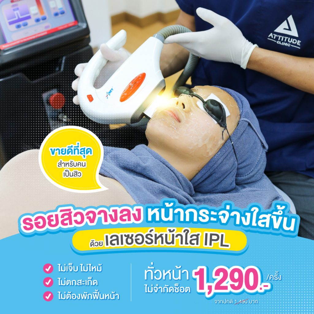 สุดยอดเลเซอร์ รักษารอยสิวเชียงใหม่ ที่ Attitude Clinic ด้วยเลเซอร์หน้าใส IPL ครอบคลุมทุกปัญหาผิว รอยแดง รอยดำจากสิวจางลง มั่นใจเกิน 100 หมออยู่ทุกวัน ดูแลเองทุกเคส รีวิวเพียบ