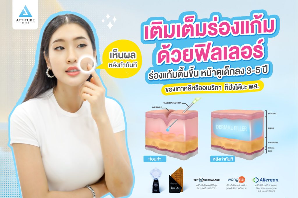 เติมเต็มร่องแก้มด้วยการฉีดฟิลเลอร์