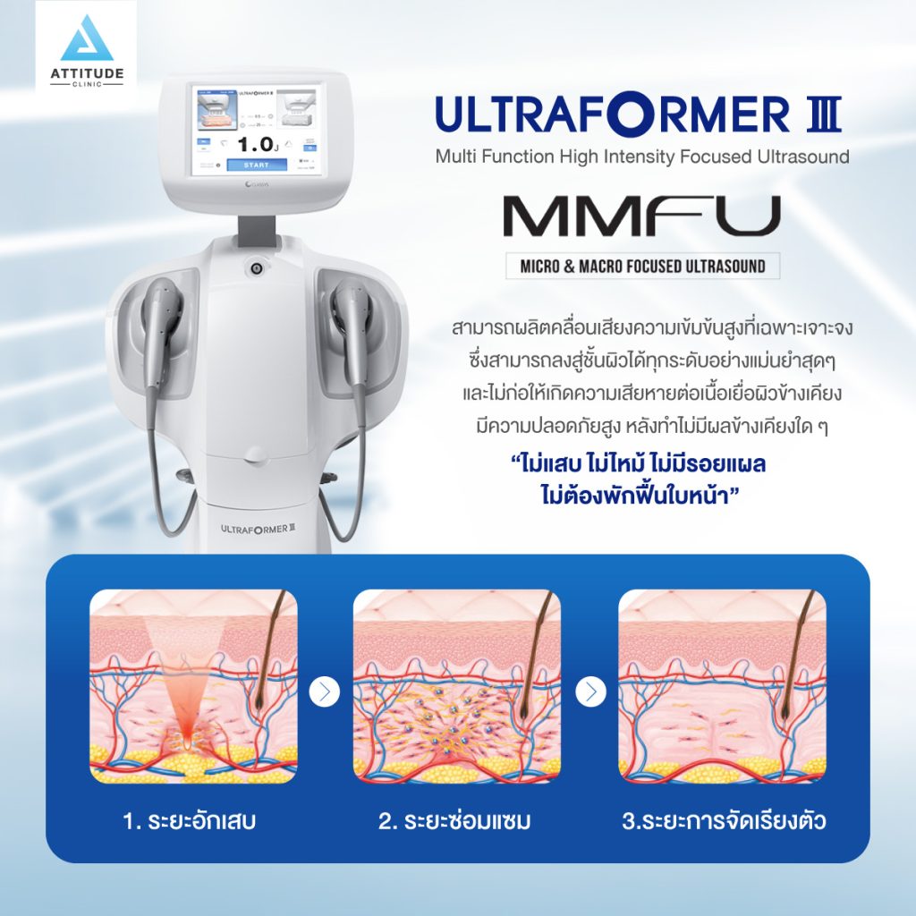 จุดเด่น ultraformer lll เชียงราย