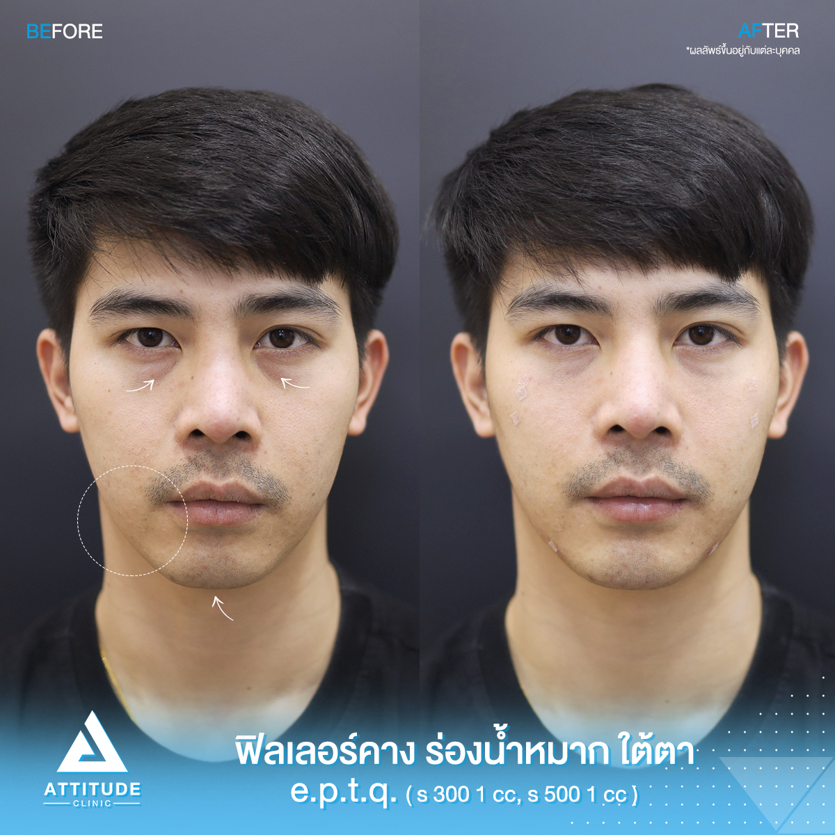 รีวิวฟิลเลอร์ e.p.t.q. 2 cc เติมร่องลึกใต้ตา เติมคาง ร่องน้ำหมาก เติมหน้าแก้ม