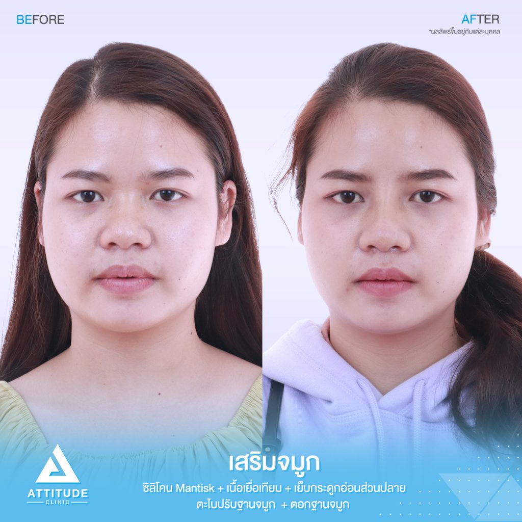 รีวิวเสริมจมูกสำหรับคนเนื้อจมูกน้อย
