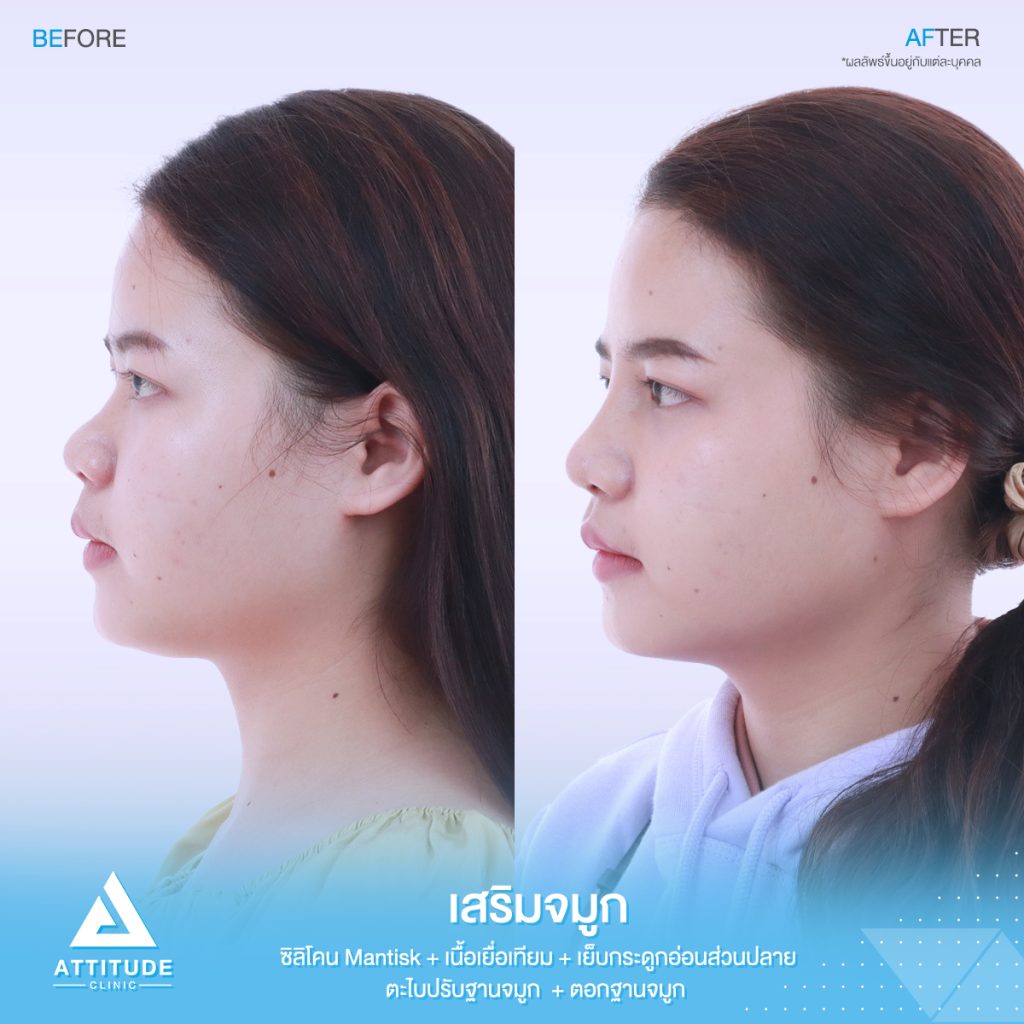 รีวิวเสริมจมูกสำหรับคนเนื้อจมูกน้อย