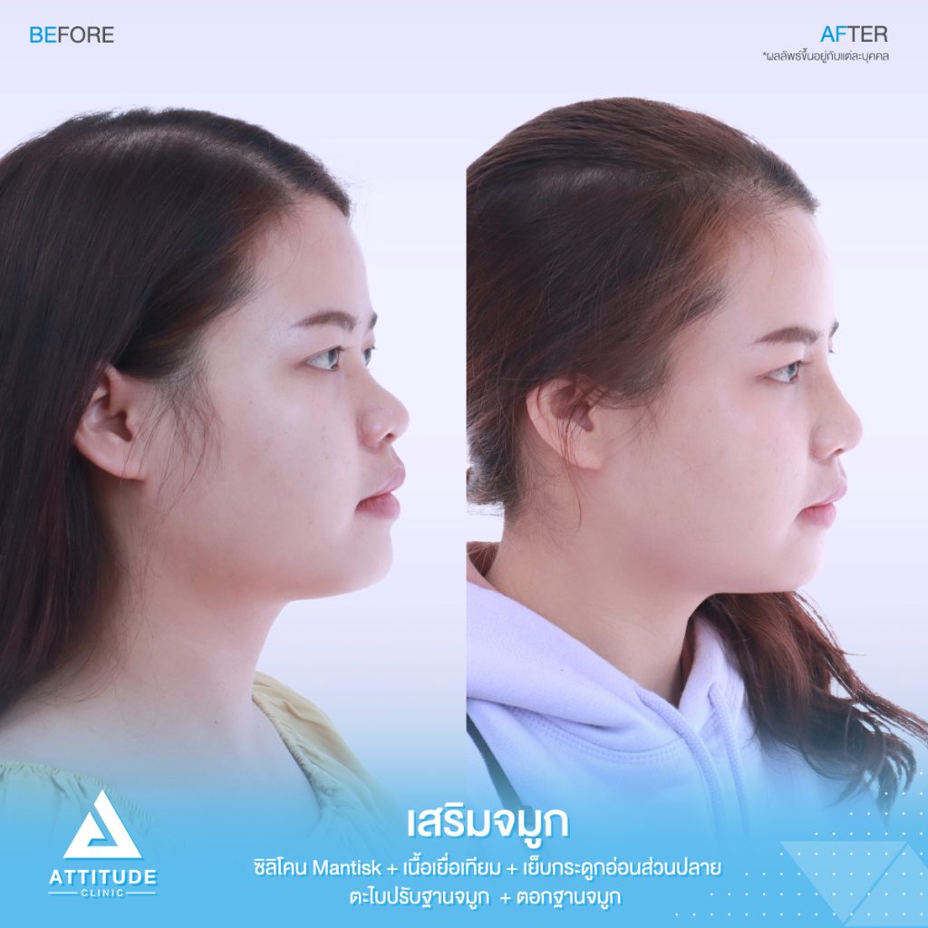 รีวิวเสริมจมูกสำหรับคนเนื้อจมูกน้อย