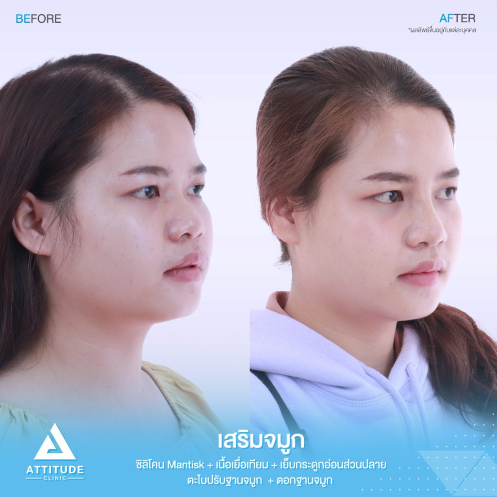 รีวิวเสริมจมูกสำหรับคนเนื้อจมูกน้อย