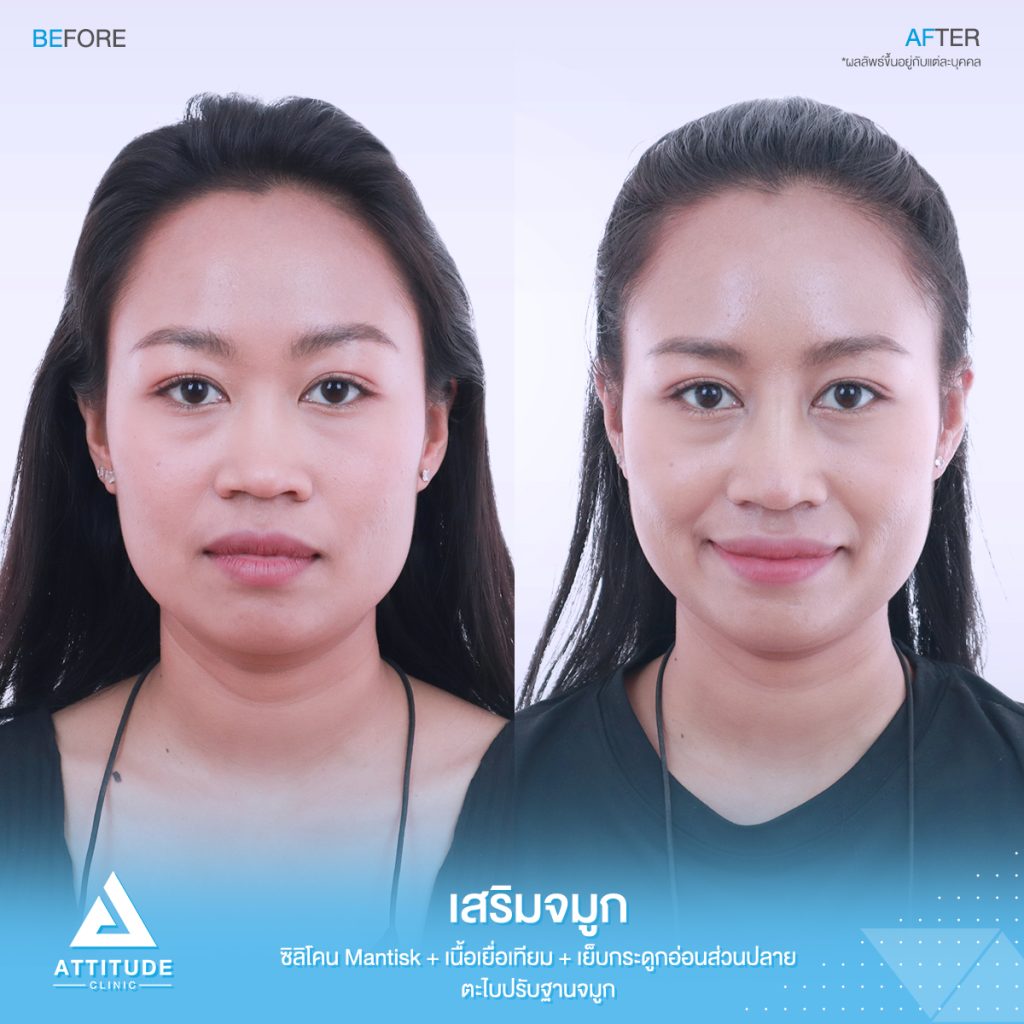 รีวิวเสริมจมูก Attitude Clinic สาขารัชดา