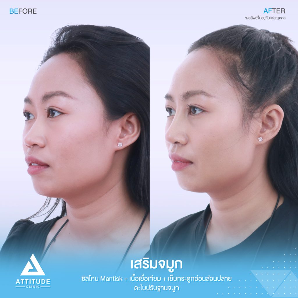 รีวิวเสริมจมูก Attitude Clinic สาขารัชดา