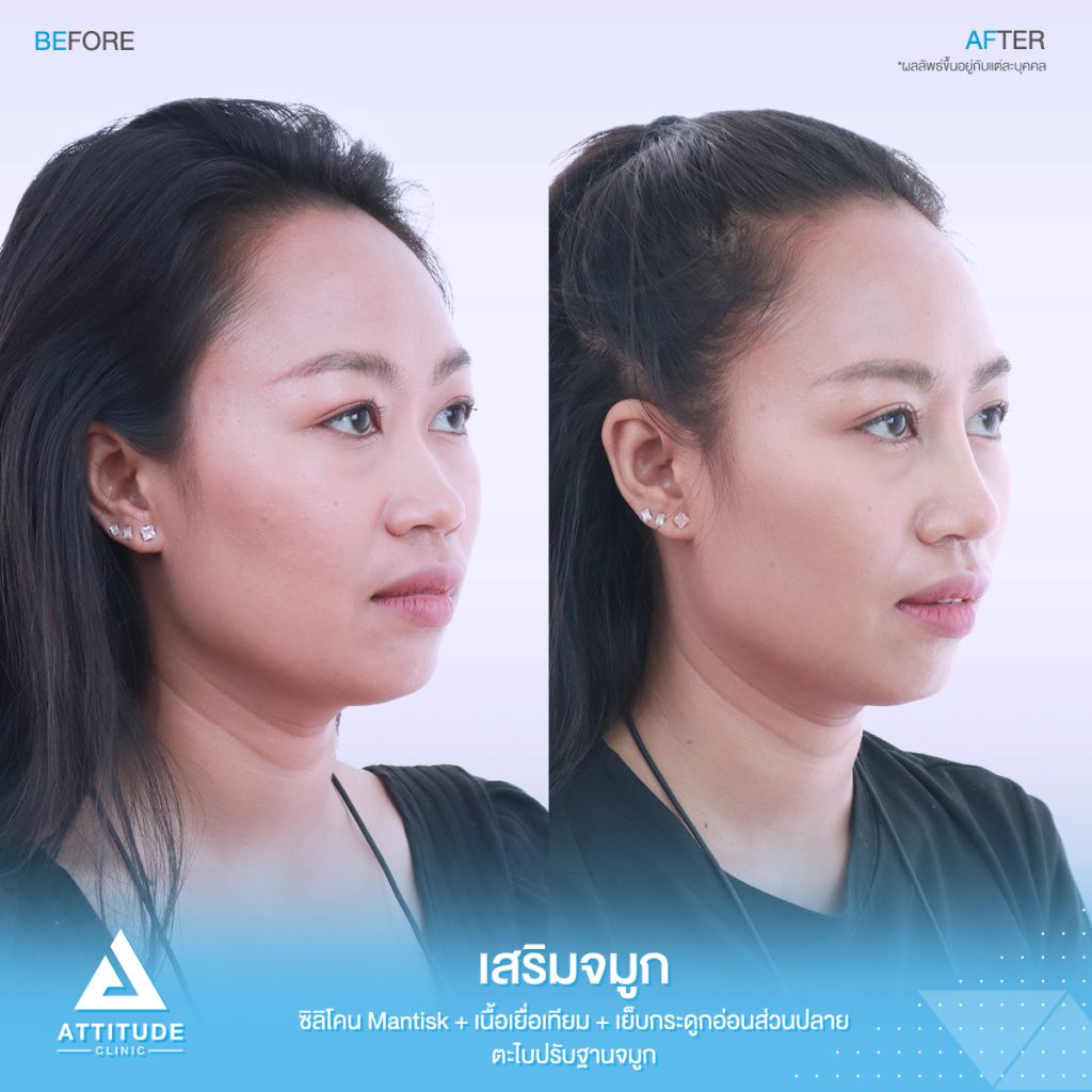 รีวิวเสริมจมูก Attitude Clinic สาขารัชดา