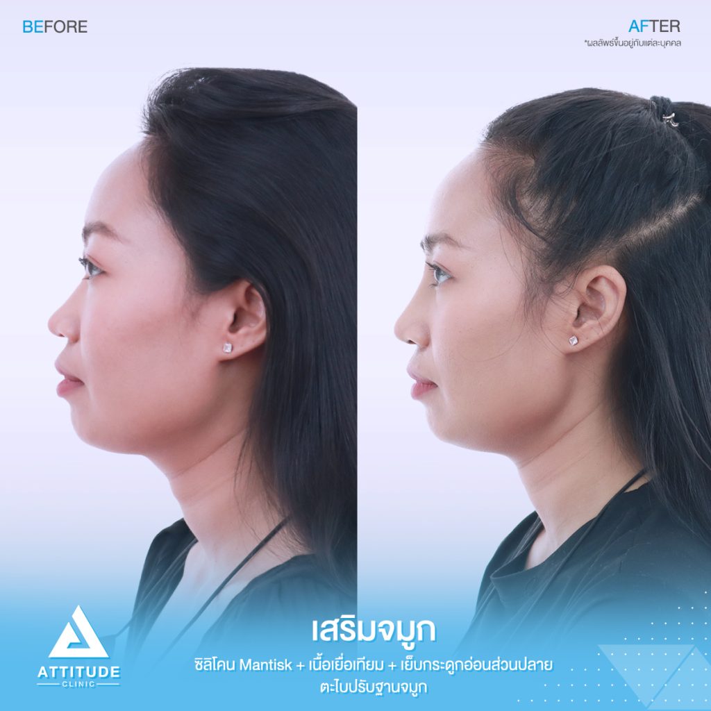 รีวิวเสริมจมูก Attitude Clinic สาขารัชดา