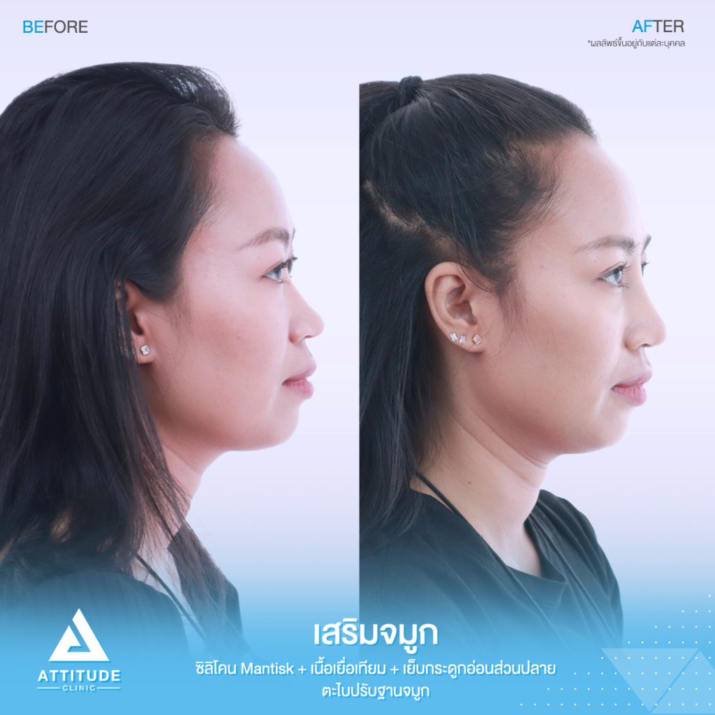 รีวิวเสริมจมูก Attitude Clinic สาขารัชดา