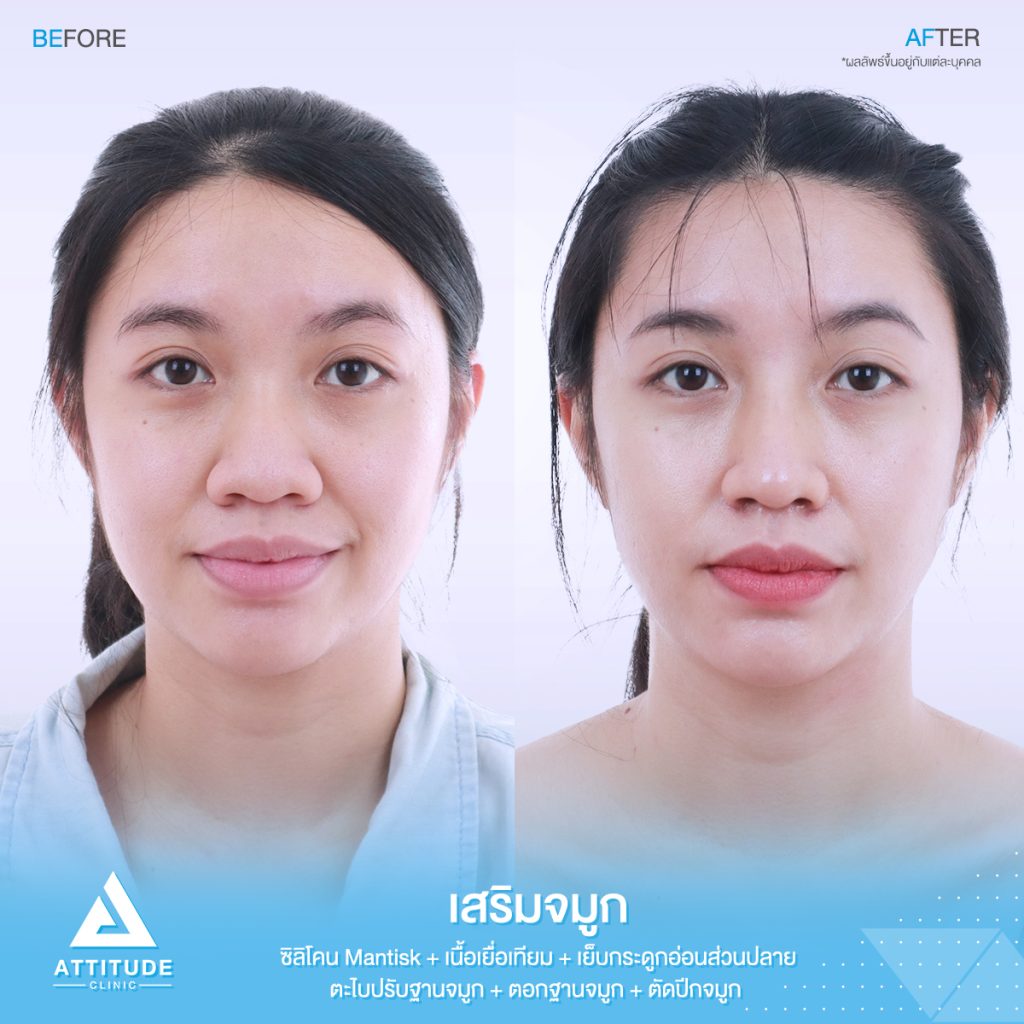 รูปรีวิวเสริมจมูกและตัดปีกจมูก