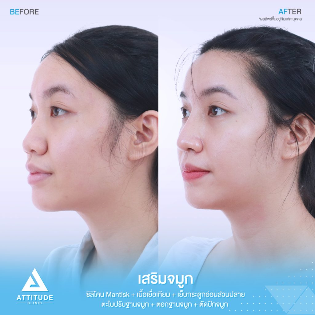 รูปรีวิวเสริมจมูกและตัดปีกจมูก