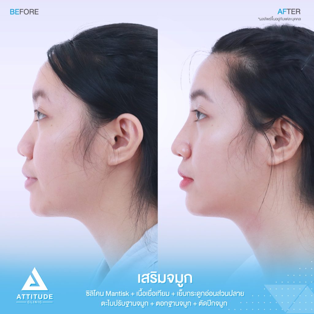 รูปรีวิวเสริมจมูกและตัดปีกจมูก