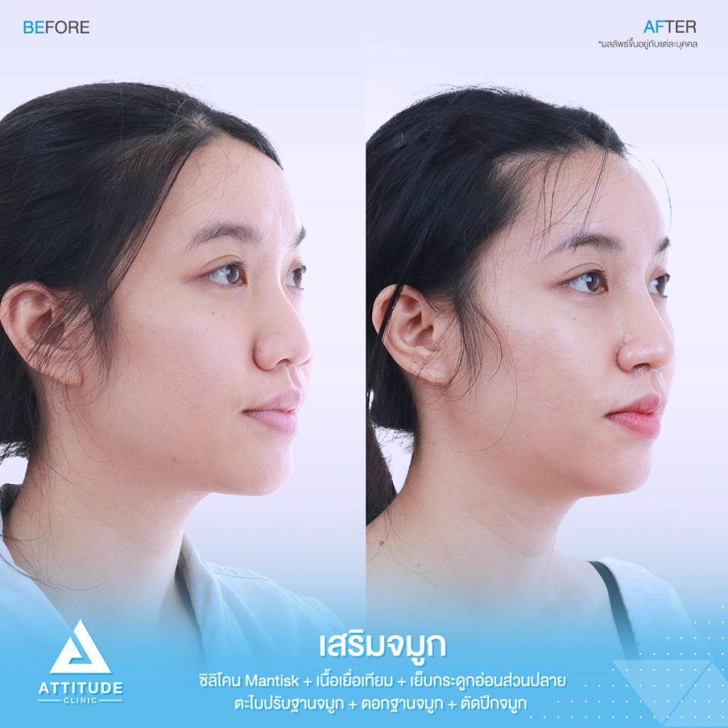 รูปรีวิวเสริมจมูกและตัดปีกจมูก