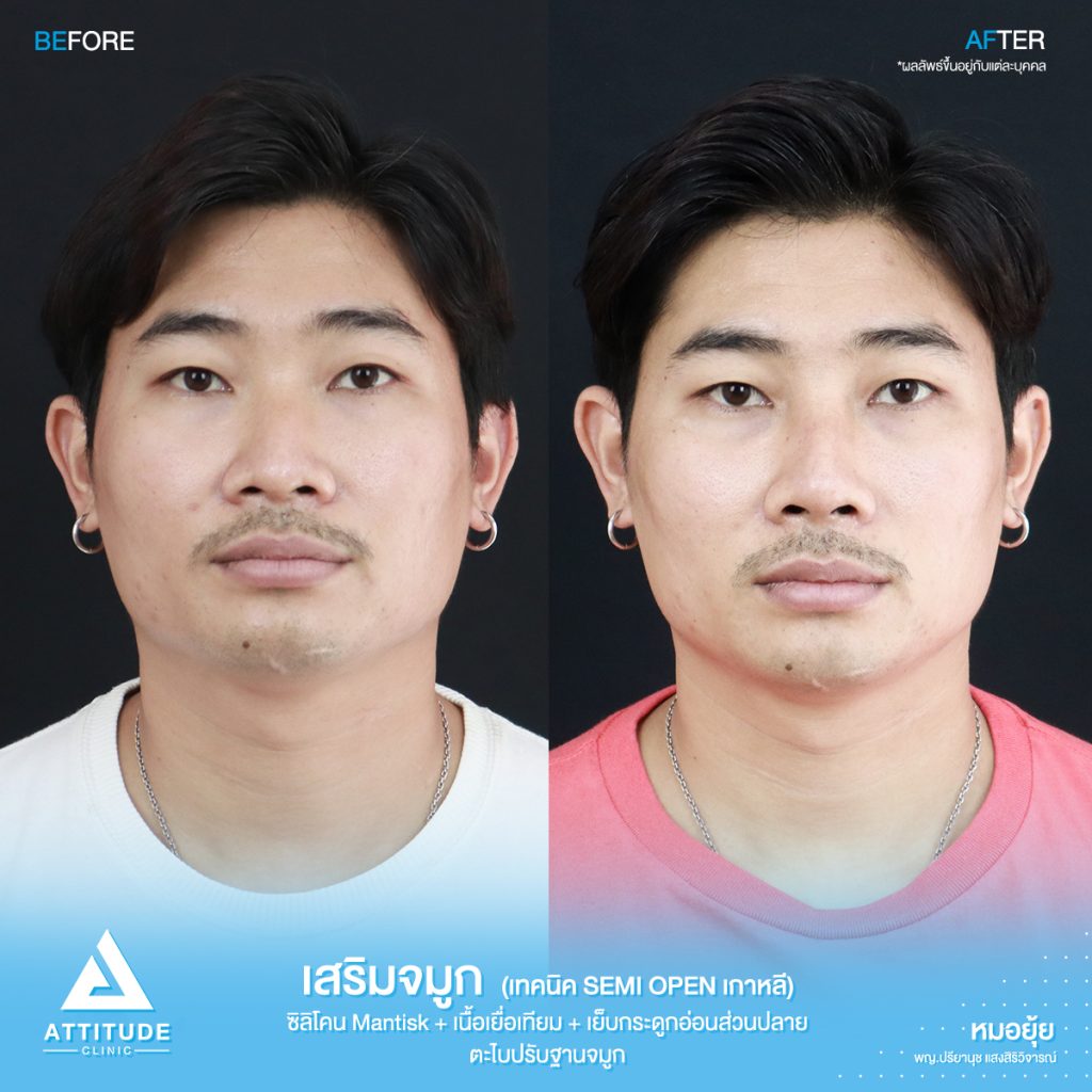 รีวิวเสริมจมูกผู้ชาย