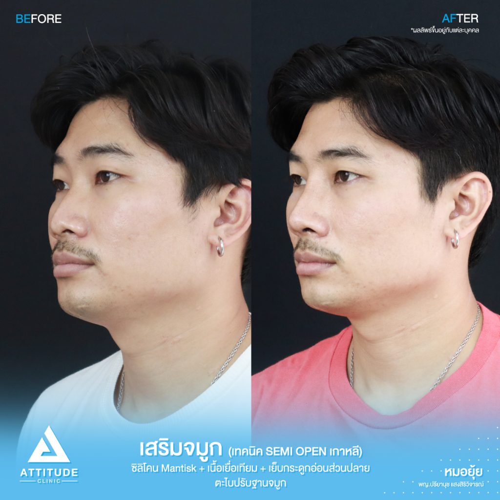 รีวิวเสริมจมูกผู้ชาย