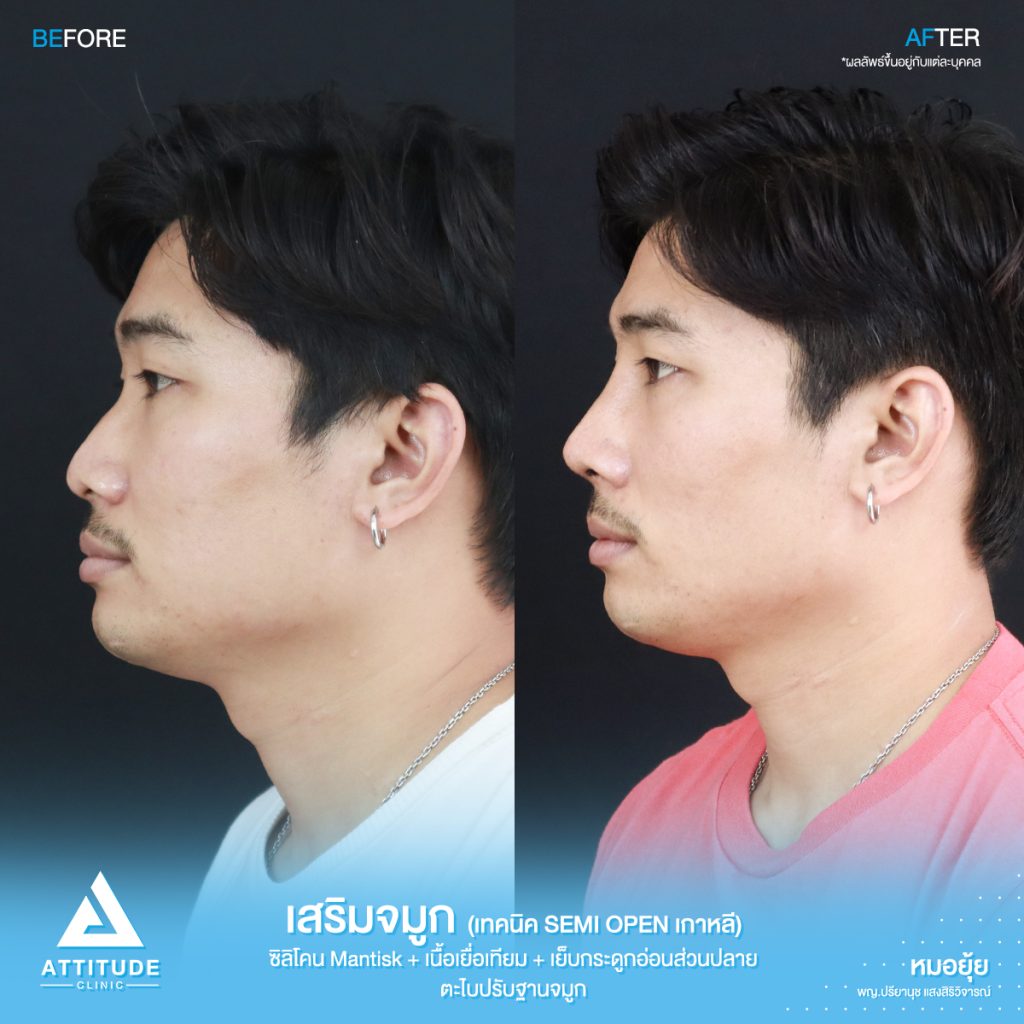 รีวิวเสริมจมูกผู้ชาย