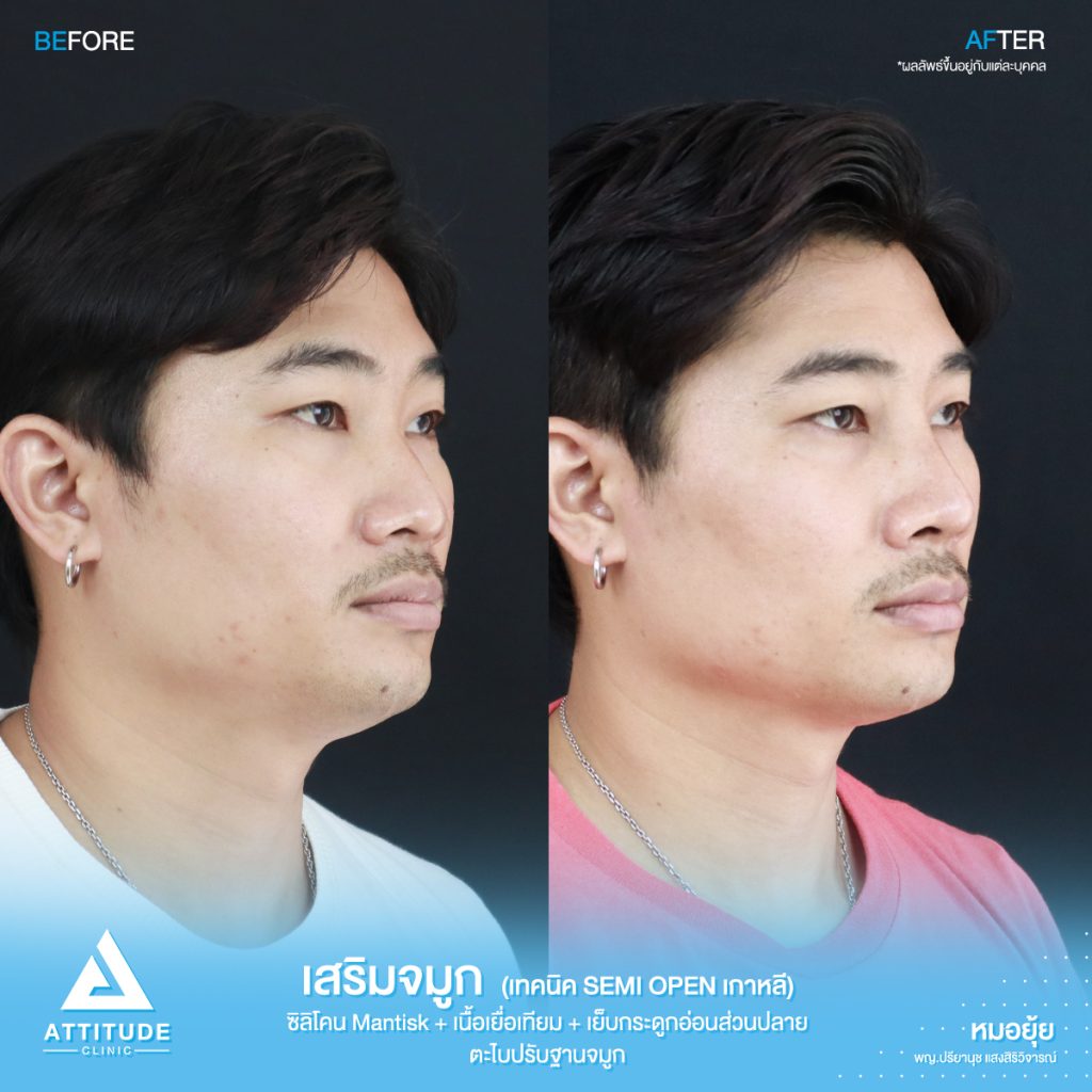 รีวิวเสริมจมูกผู้ชาย