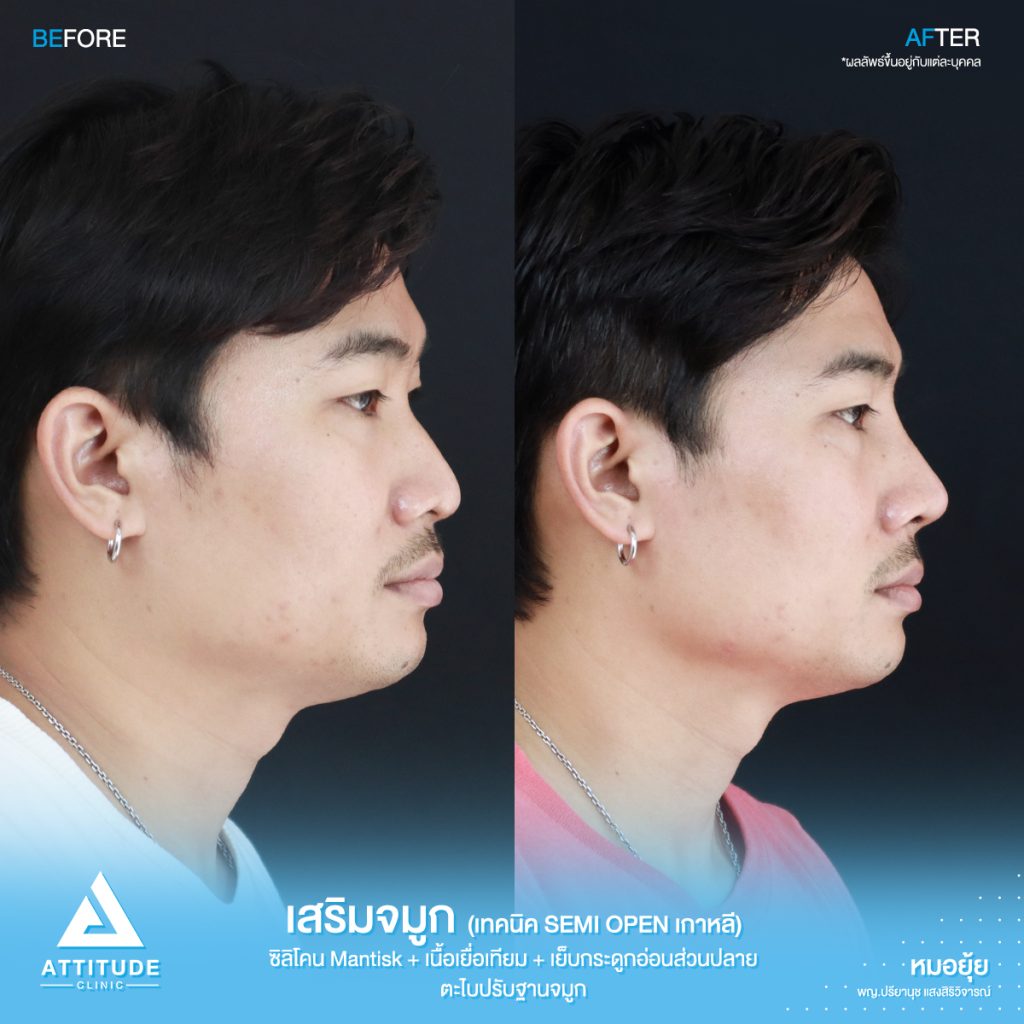 รีวิวเสริมจมูกผู้ชาย