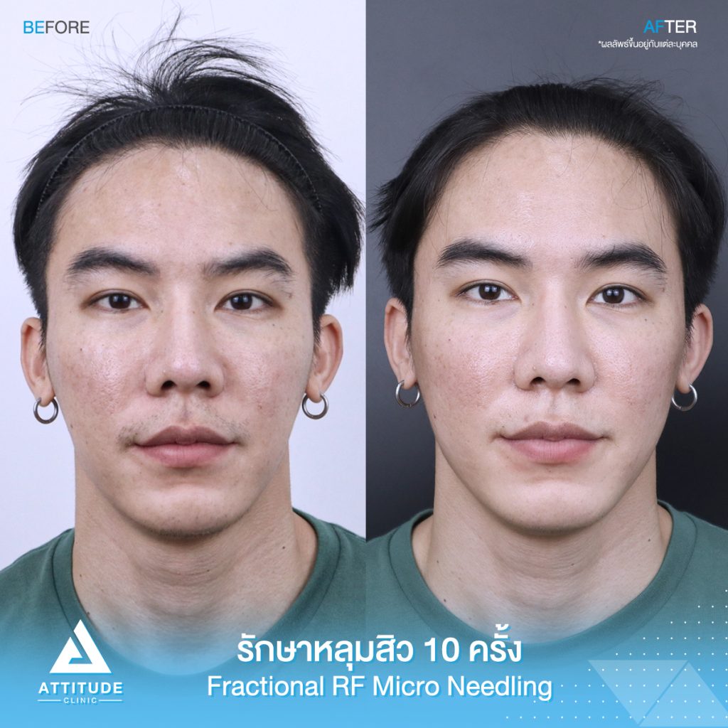 รูปภาพนี้มี Alt แอตทริบิวต์เป็นค่าว่าง ชื่อไฟล์คือ Attitude-Review-CM-20-FRF-มอร์ฟีน-01-1024x1024.jpeg