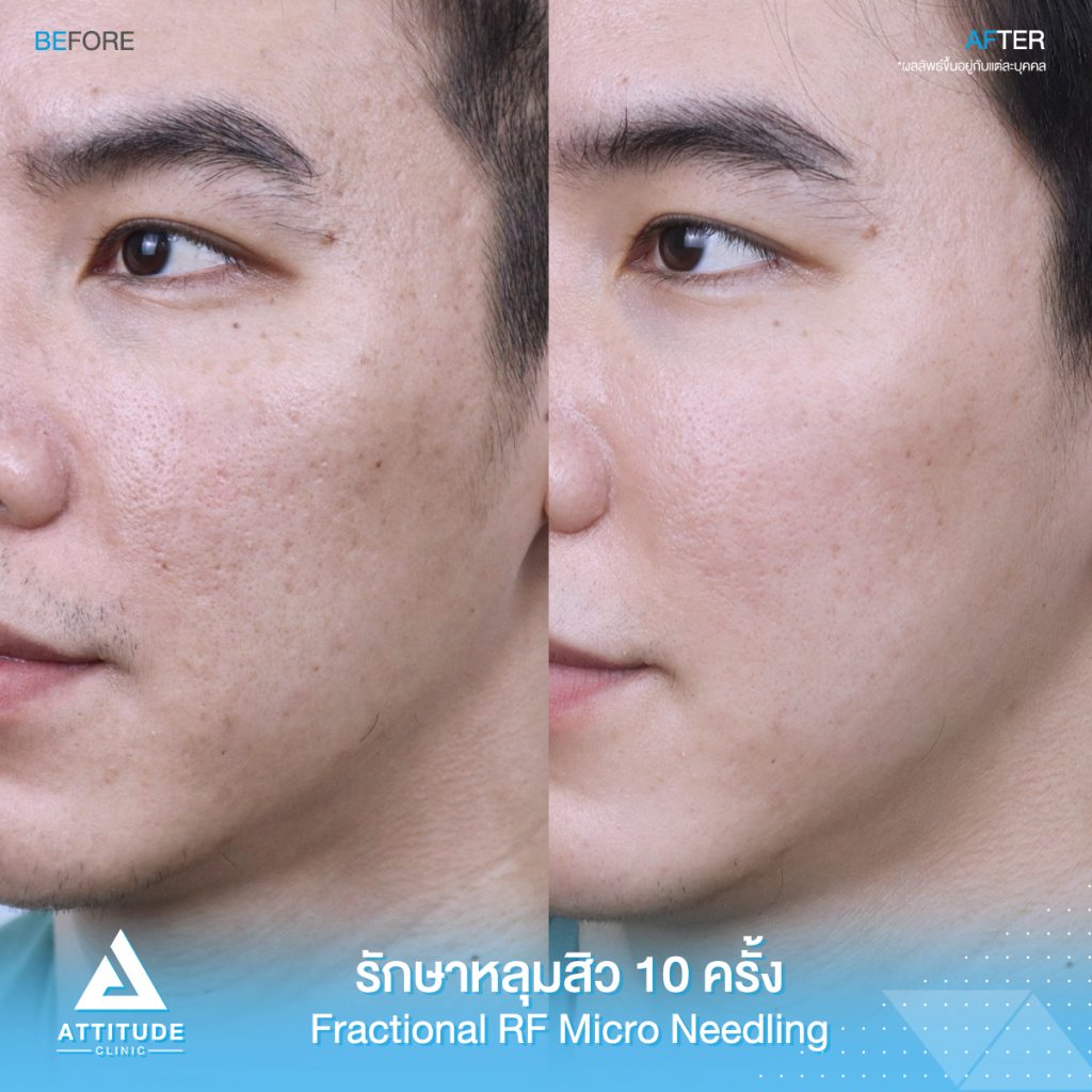 รูปภาพนี้มี Alt แอตทริบิวต์เป็นค่าว่าง ชื่อไฟล์คือ Attitude-Review-CM-20-FRF-มอร์ฟีน-02-1024x1024.jpeg