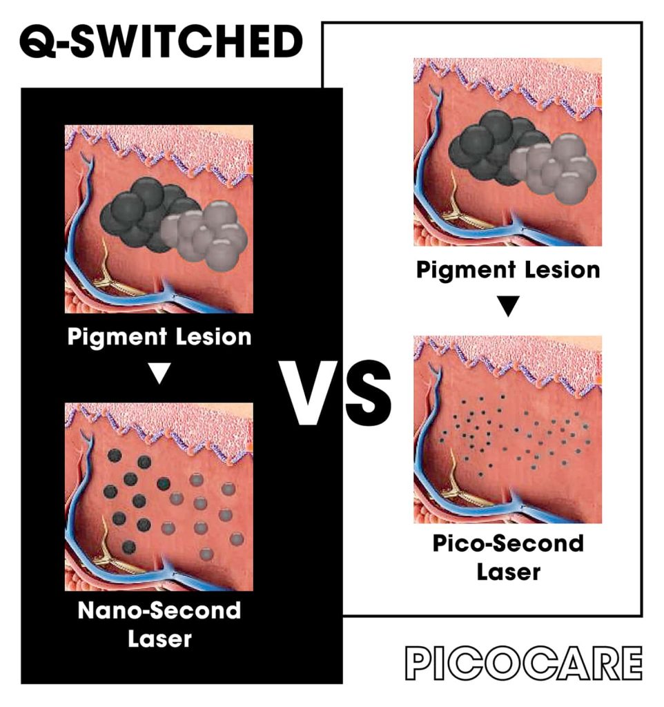 Picocare 450 : Picosecond Laser แตกต่างจาก Q-Switched ยังไง ?