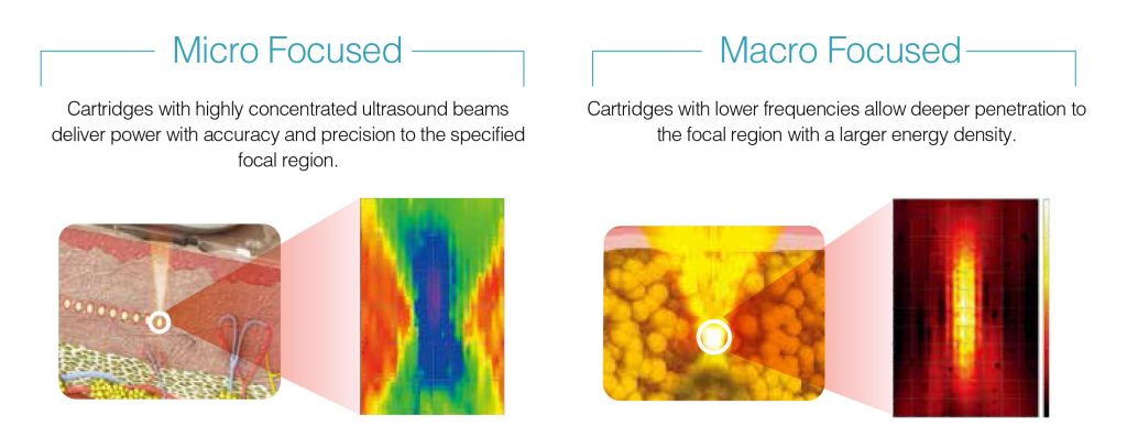 เทคโนโลยี MMFU : Micro &Macro Focused Ultrasound ของเครื่อง Ultraformer lll